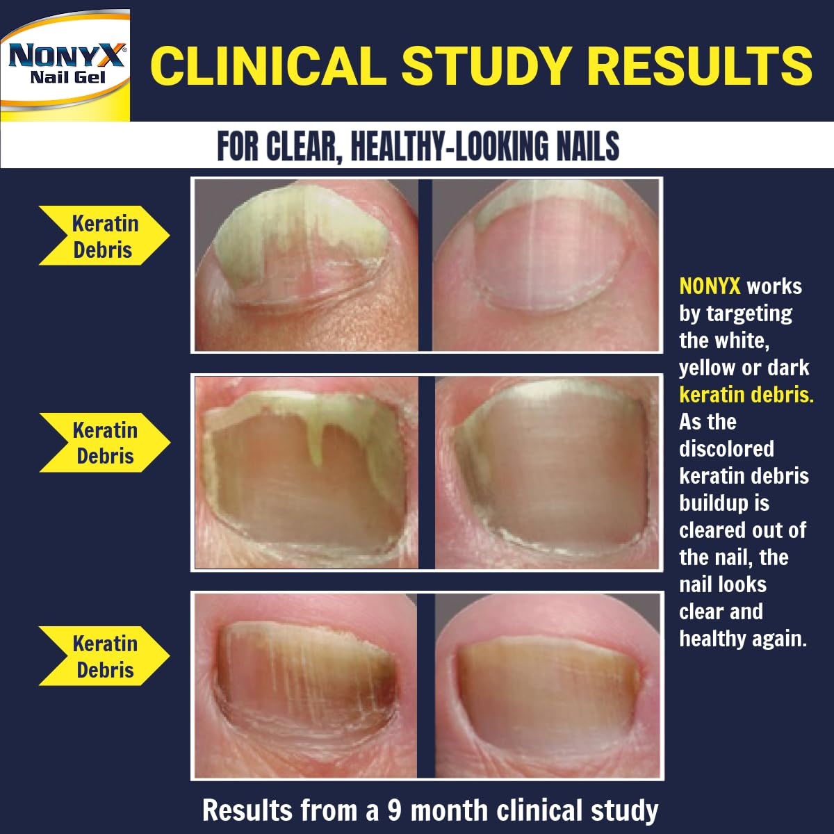 NONYX Fungal Nail Clarifying Gel | Clinically Proven for Discolored, Thick, Brittle, Yellow, Lifted, and other signs of Fungus-Damaged Toenails | 90% of Nails Improve | Over 8 million sold