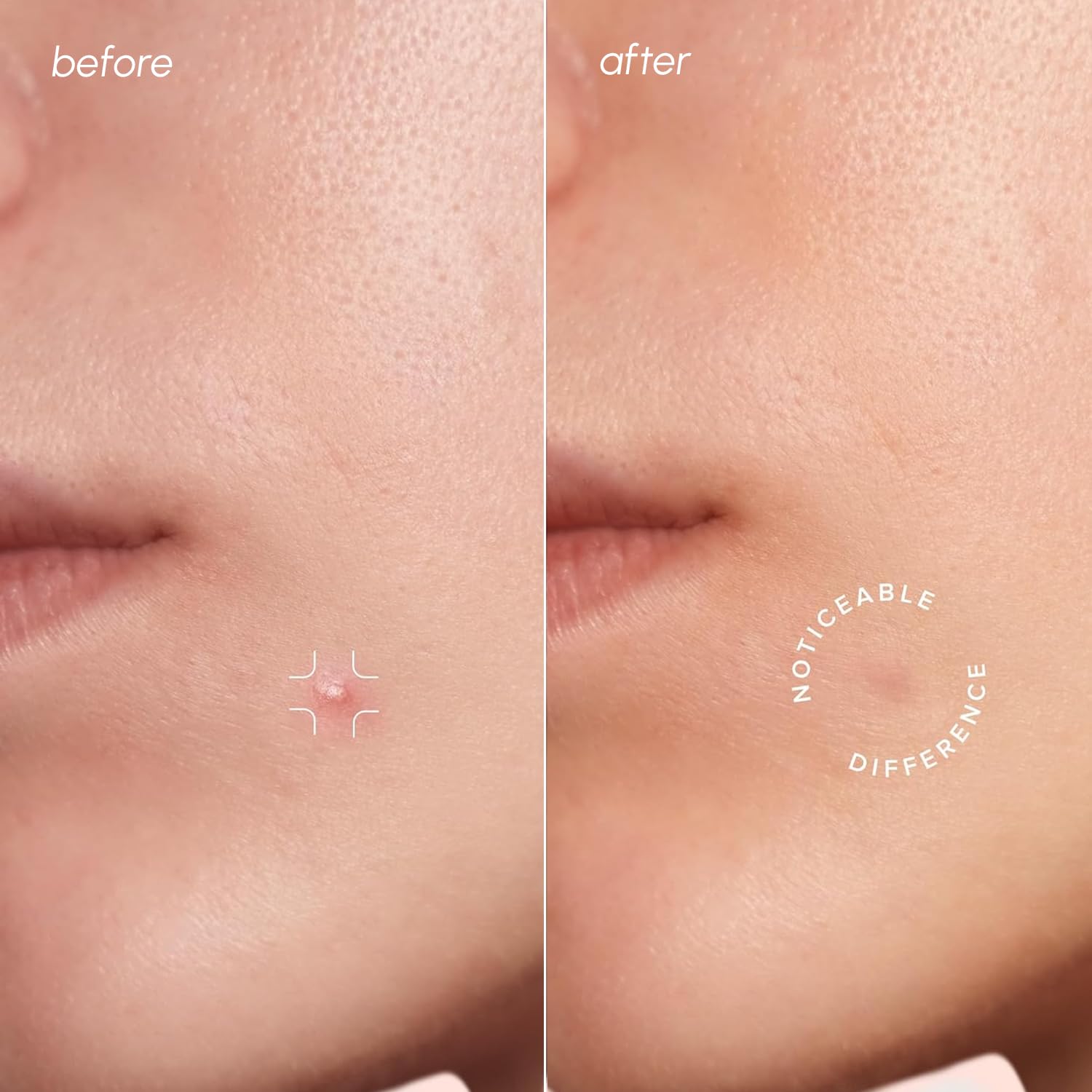 MAREE Pimple Patches for Face - Acne Clearing Device - Clear Acne Patches for Face - Invisible Hydrocolloid Patch Parches Para Acne Stickers Zit Dots - Cystic Zit Healing Blemish Pinple Covers