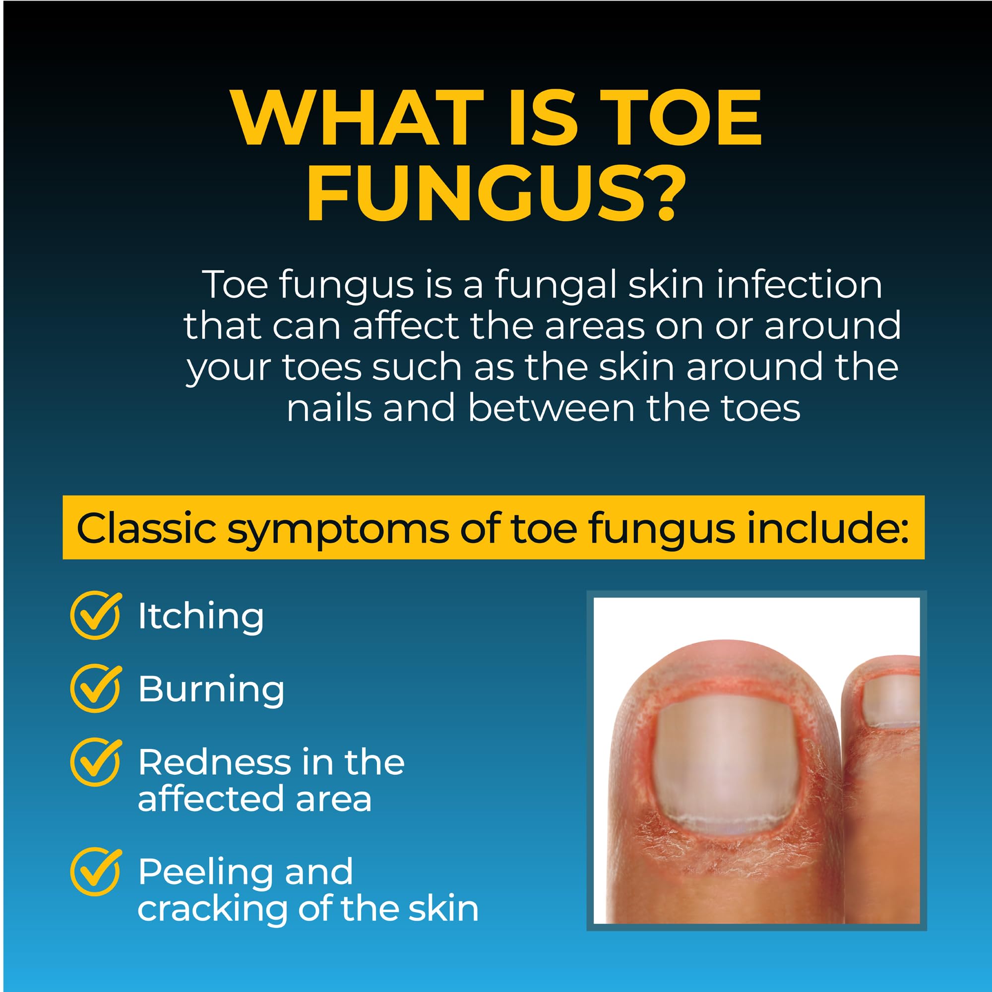 Fungi-Nail Anti-Fungal Liquid Solution, Kills Fungus That Can Lead to Nail & Athlete's Foot with Tolnaftate & Clinically Proven to Cure and Prevent Fungal Infections 1 Fl Oz (Pack of 1)