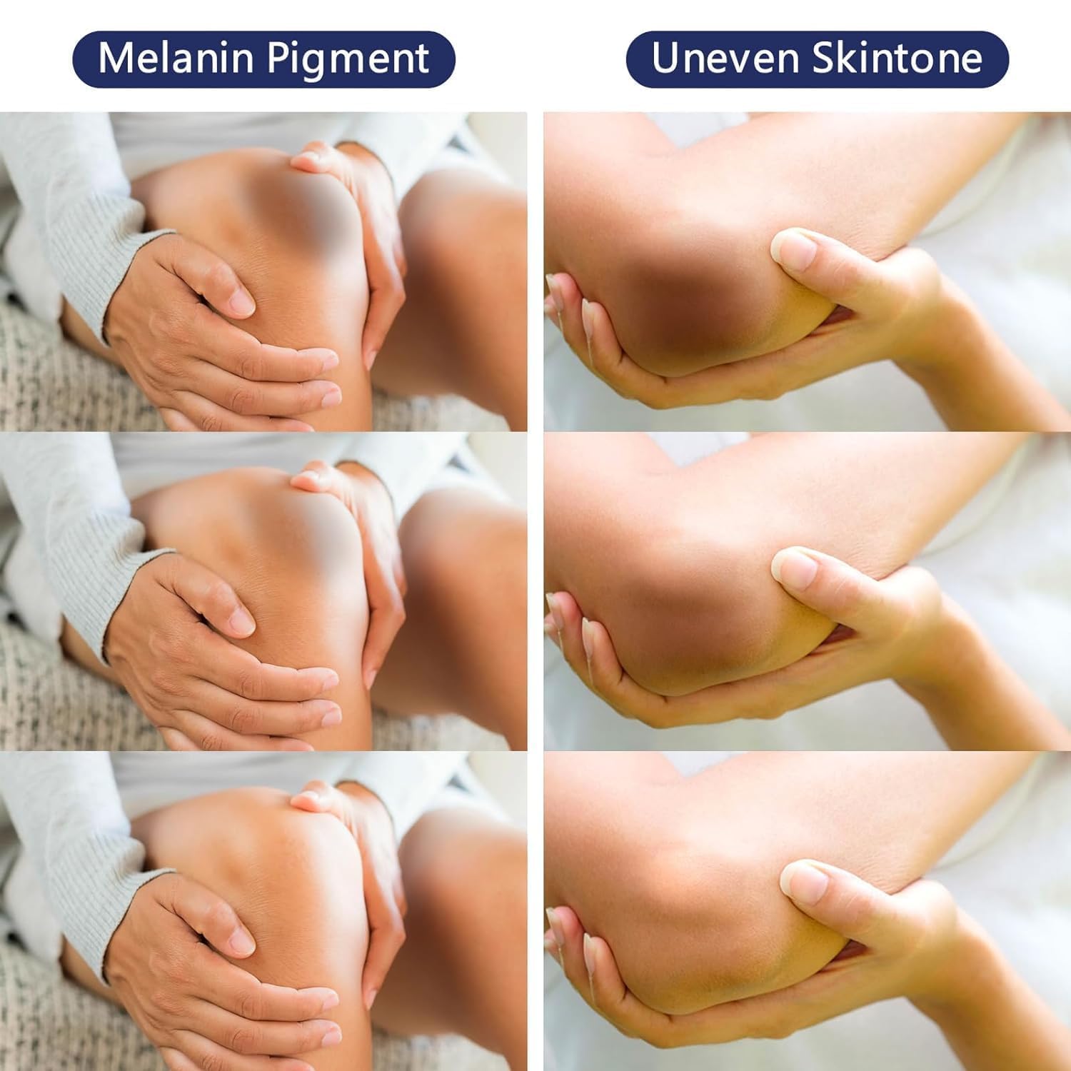 Skin Lightening Cream Gel For Body Intimate Area With Niacinamide, Arbutin, Vitamin C For Private Parts, Underarm, Knees, Elbows, Inner Thigh, Bikini Areas, armpit Skin Whitening Bleaching Cream 30ML