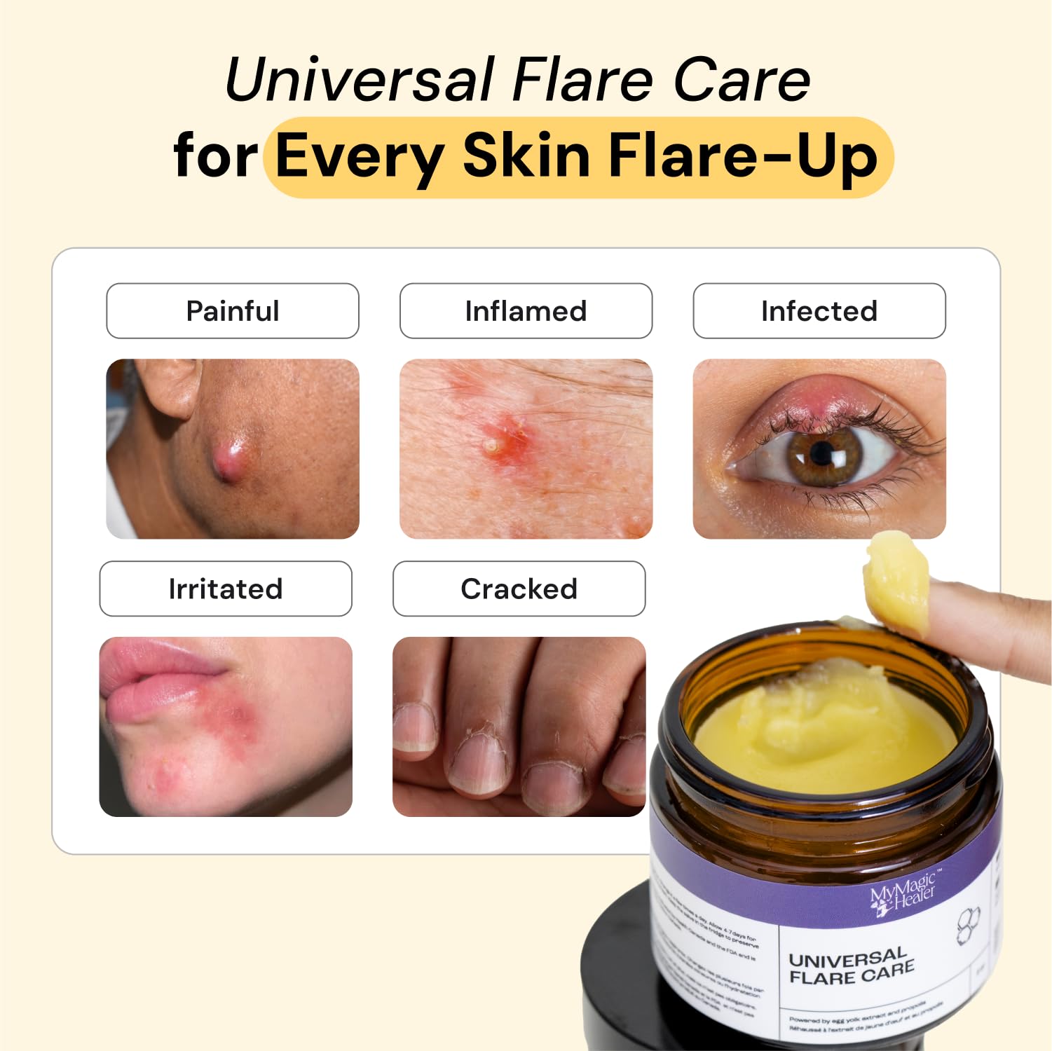 MyMagicHealer Universal Flare Care | Drawing Salve for HS, Boils, Cysts, Hemorrhoids, Pilonidal Cyst, Abscess | Anti-Chafing, Wound Care, Relief for Itching Skin w/Propolis & Egg Yolk Extract 1 oz