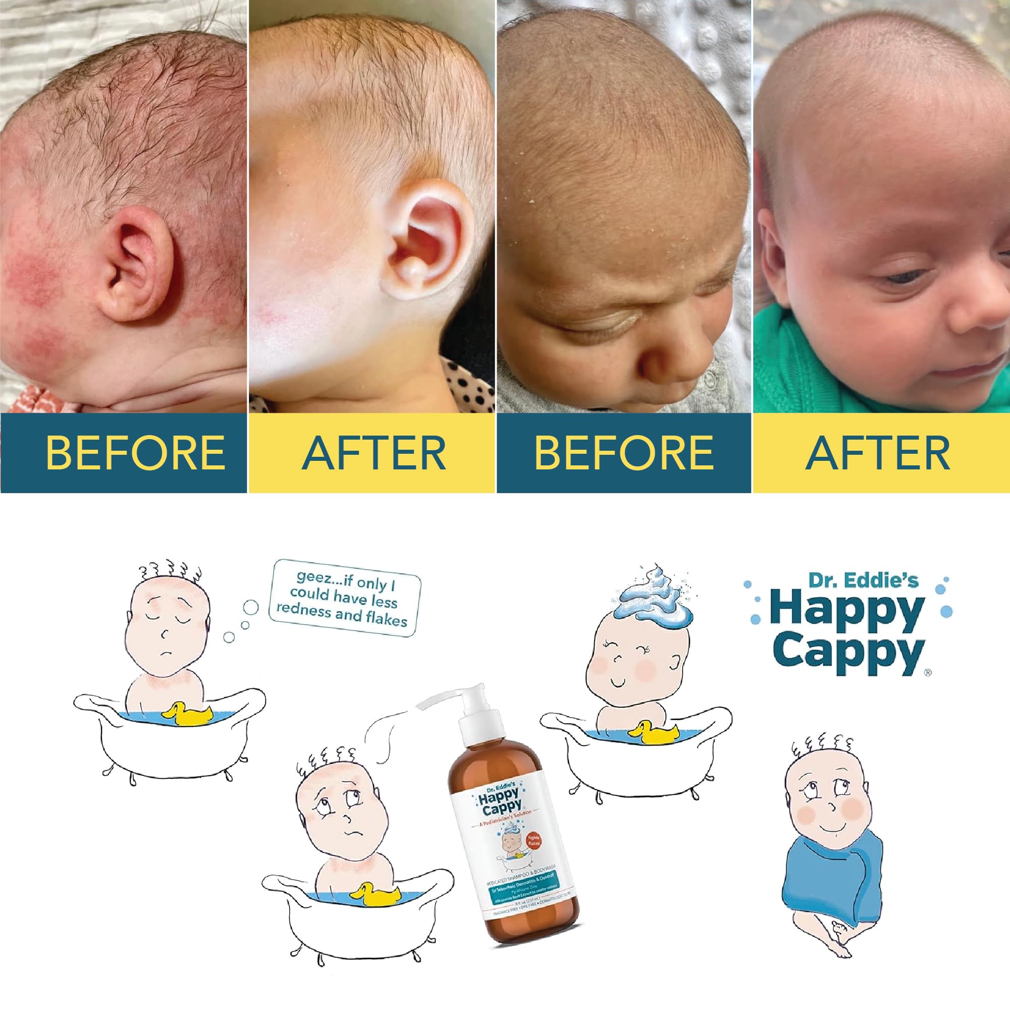 Happy Cappy Dr. Eddie’s Medicated Shampoo and Body Wash- Baby Dandruff Shampoo, Helps Cradle Cap and Seborrheic Dermatitis, Reduces Flakes and Redness, Dermatologist Tested, Fragrance-Free - 8 Fl Oz